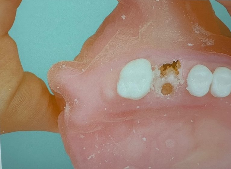 Detailaufnahme einer Zahnsituation am Modell